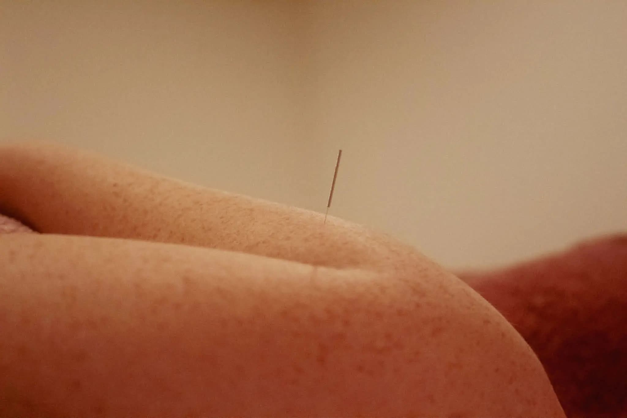 Free the Qi Acupuncture treatment room